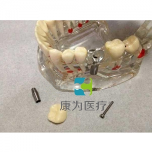 “康為醫療”綜合病理水晶牙列模型(可拆)
