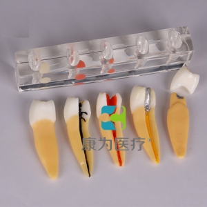 “康為醫療”牙髓病治療模型