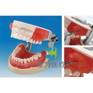 “康为医疗”国家医师考试专用牙槽脓肿切开与牙体预备模型