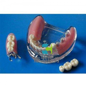 “康為醫療”種植牙說明用模型
