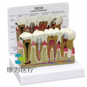 “康為醫療”醫患關系溝通模型-前磨牙和臼齒放大模型（醫學指導模型）